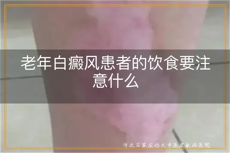 老年白癜风患者的饮食要注意什么