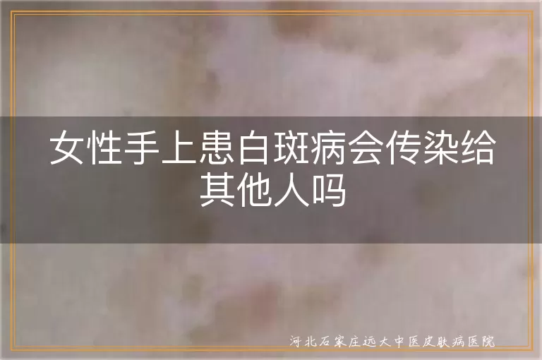 女性手部白癜风不具传染真相,白斑碰触不会传染给同事家人,手上白癜风白斑拥抱共餐安全