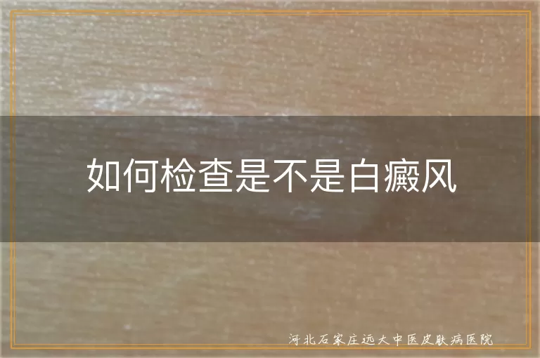 白癜风初步自查方法,白斑是否属于白癜风,白癜风确诊检查流程