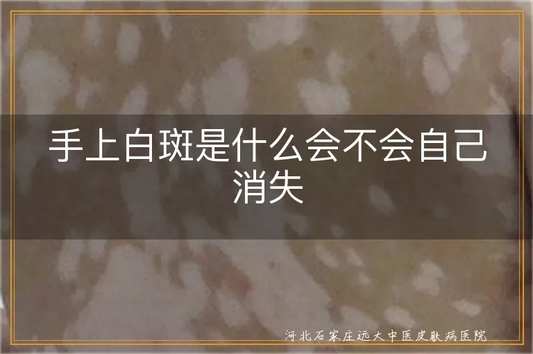 手上白斑是什么会不会自己消失