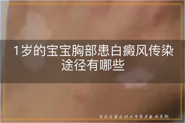 1岁宝宝胸部白斑会传给别人吗,婴幼儿白癜风不会通过接触传染,宝宝胸口白斑属于非传染性白癜风