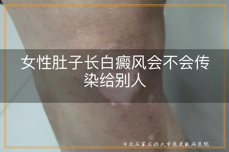女性肚子白斑会传染吗,肚子白癜风传染风险,白斑白癜风女性会传染