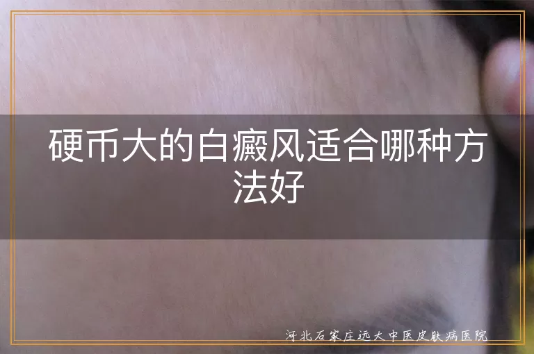 硬币大白斑哪种疗法靠谱,白癜风小面积怎么治,白斑硬币大小最佳方案