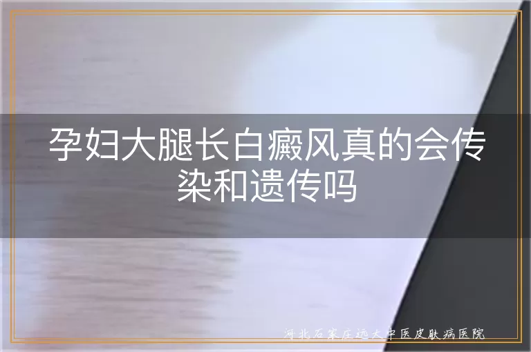 孕期大腿白斑会不会遗传,孕妇白癜风会传染给胎儿吗,大腿白癜风白斑遗传几率