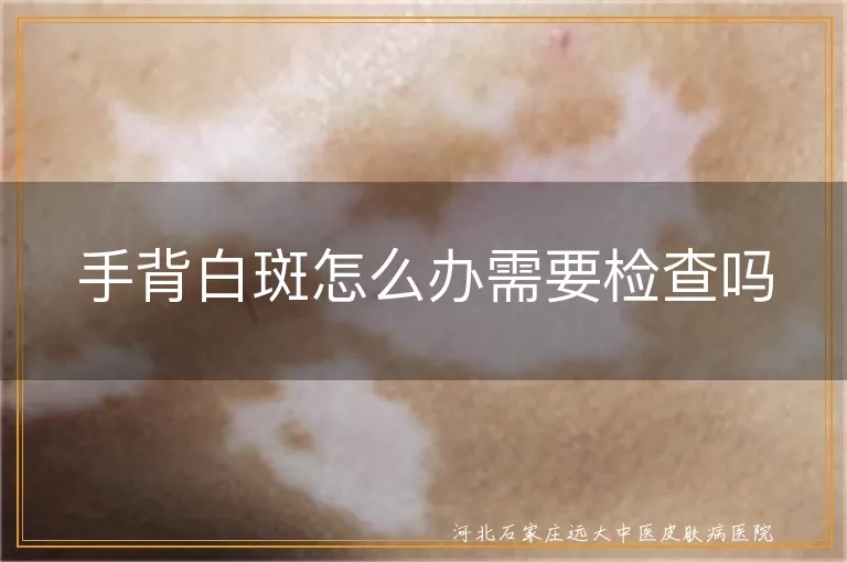 手背白癜风需不需要检查,白斑长在手上要不要检查,手背白斑是不是白癜风