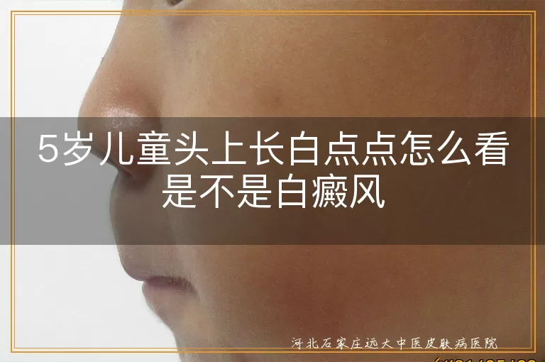 5岁娃白斑初筛技巧,儿童头皮白癜风辨别,小儿白斑与白癜风区分