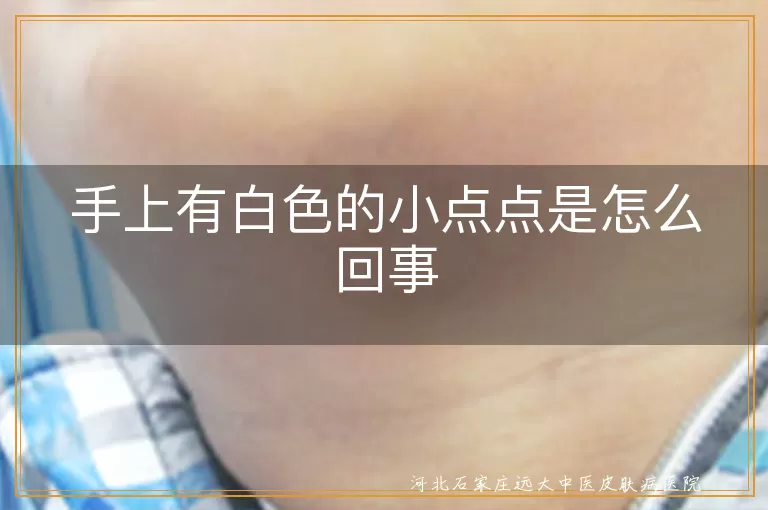 手上出现白斑是什么原因,手指白癜风早期症状,手部白斑与白癜风区别