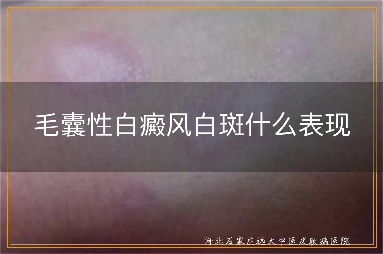 毛囊型白癜风有哪些症状,白斑累及毛发的特征,毛囊性白癜风皮损特点