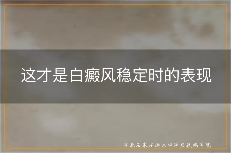 白癜风稳定期有哪些特征,白斑不再扩散的表现,如何判断白癜风进入稳定期