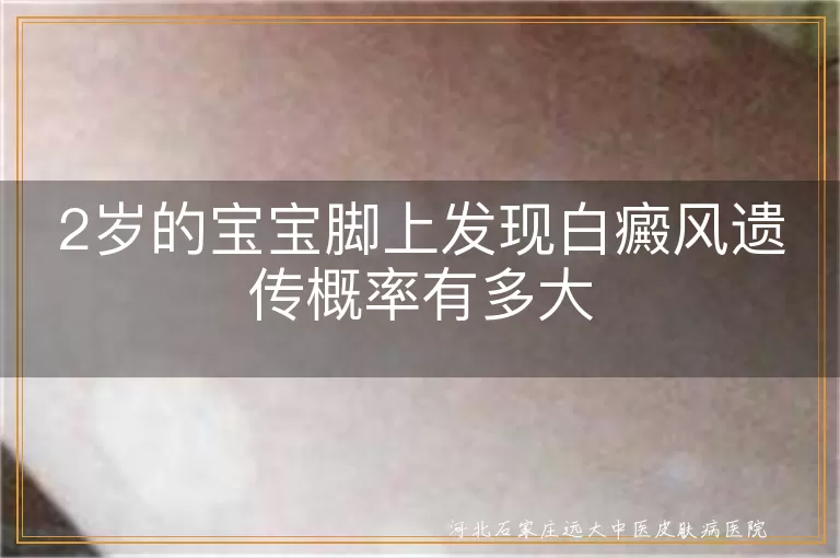 幼儿脚部白癜风遗传几率有多大,2岁宝宝白斑是不是遗传导致,婴幼儿白癜风家族遗传风险高吗