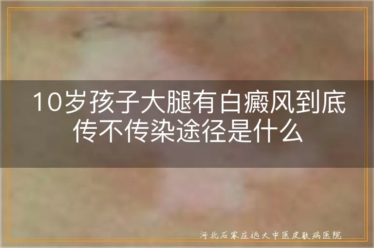 10岁儿童白癜风传染吗,白癜风会不会传染给别人,白斑病传染途径有哪些