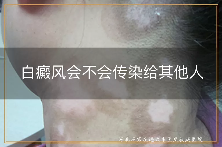 白癜风会不会传染给其他人