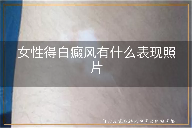 女性得白癜风有什么表现照片