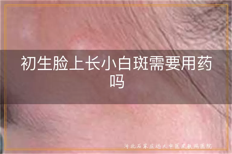 初生儿面部白斑需要用药吗,婴儿白癜风初期需要治疗吗,新生儿白斑病如何判断