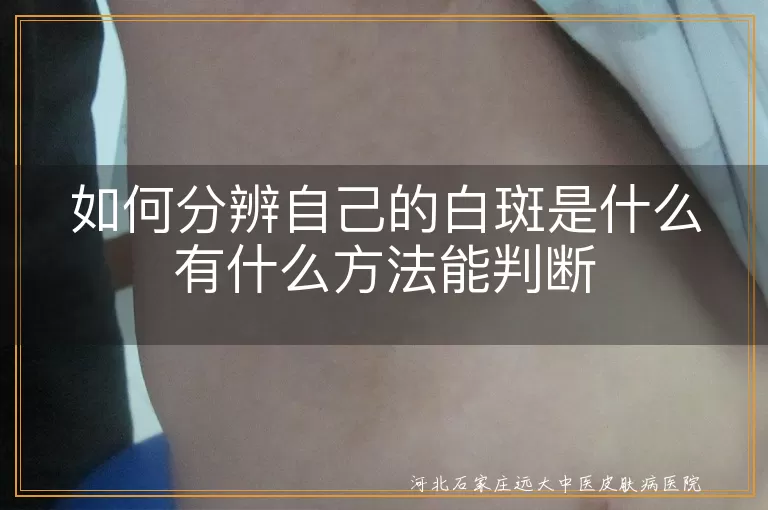 `白斑如何自我初步辨别方法,白癜风临床诊断依据有哪些,皮肤出现白斑怎么判断病因`