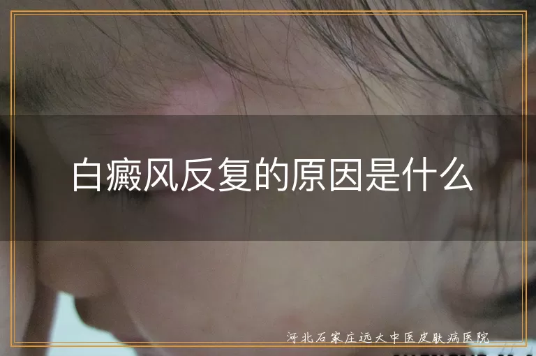 白癜风反复的原因是什么