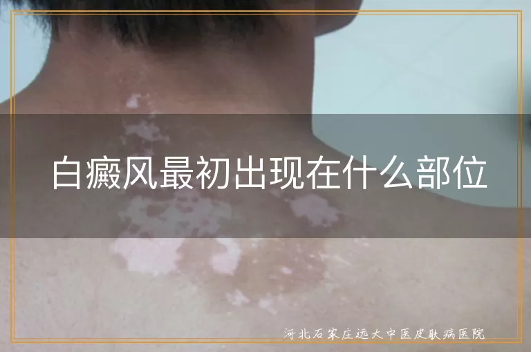白癜风最初出现在什么部位