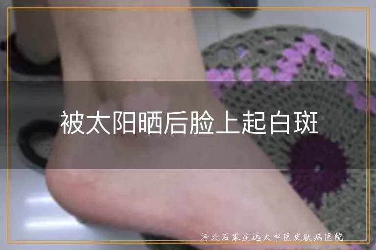 被太阳晒后脸上起白斑