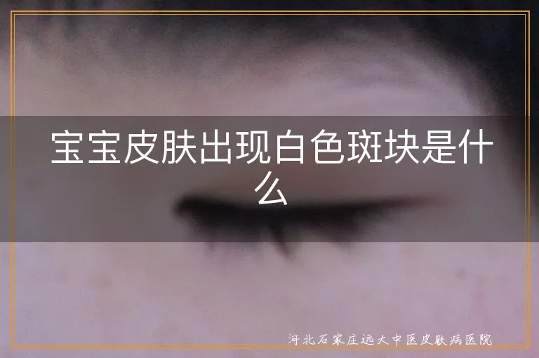 宝宝皮肤出现白色斑块是什么