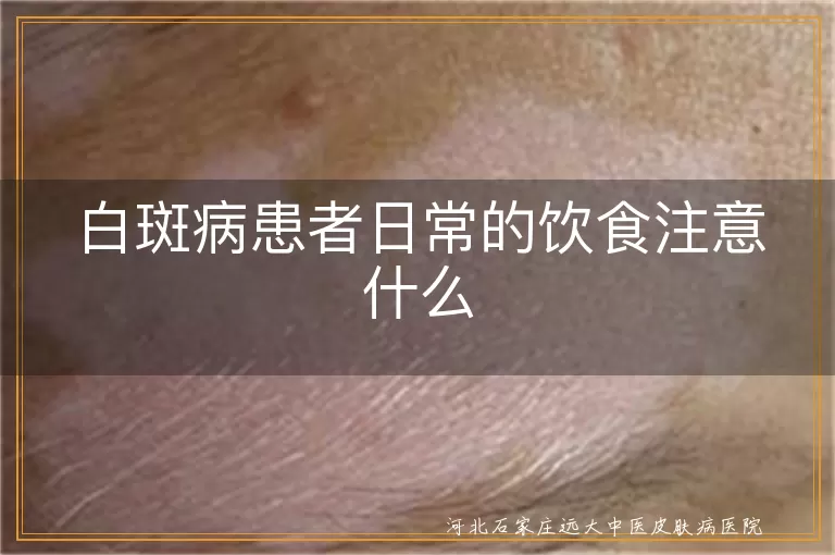 白斑病患者日常的饮食注意什么