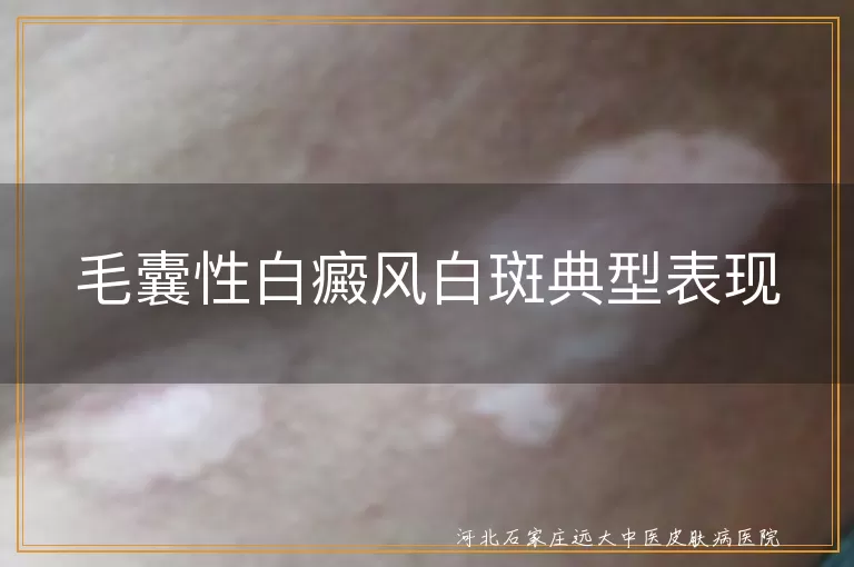 毛囊性白癜风白斑典型表现
