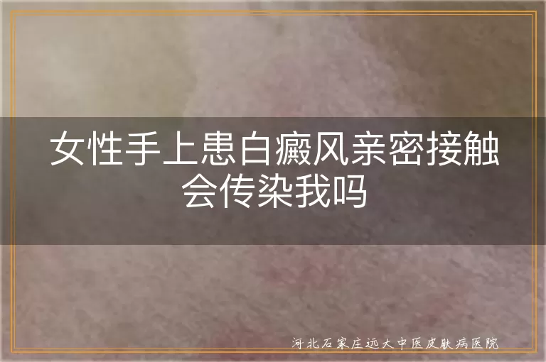女性手部白癜风传染吗,与白癜风患者亲密接触会传染吗,手上白斑会不会传染给家人