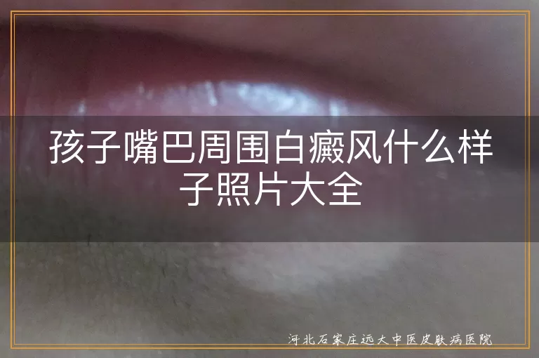 孩子嘴巴周围白癜风什么样子照片大全