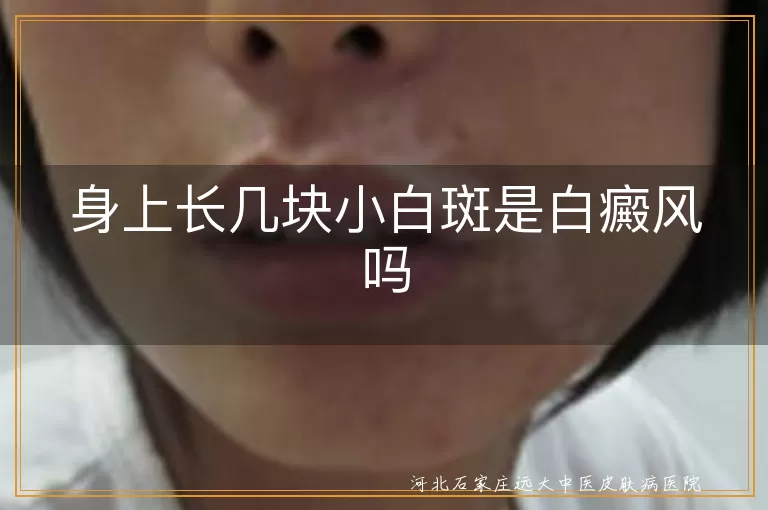 身上长几块小白斑是白癜风吗