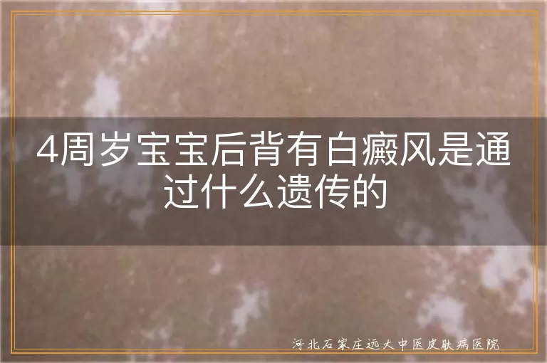 4岁幼儿后背白癜风遗传机制,儿童白癜风家族遗传规律,婴幼儿白斑病遗传方式