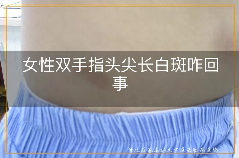 女性指尖白斑是什么原因,手指白癜风早期症状,女性手部白斑怎么治