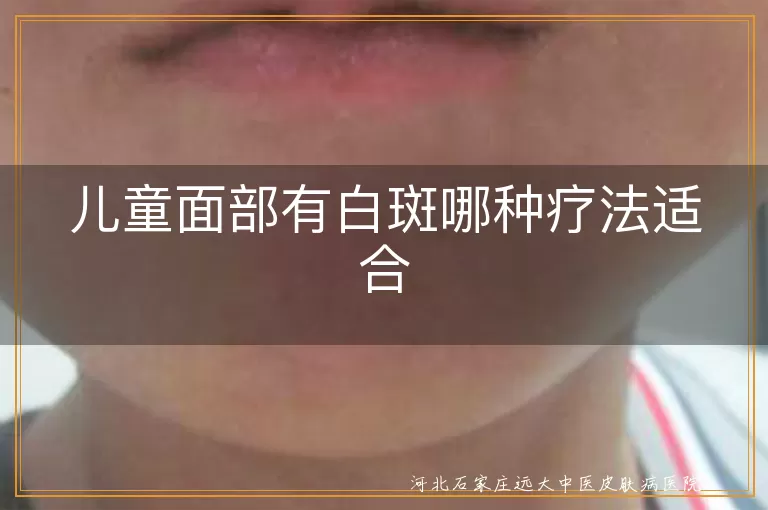 儿童面部有白斑哪种疗法适合