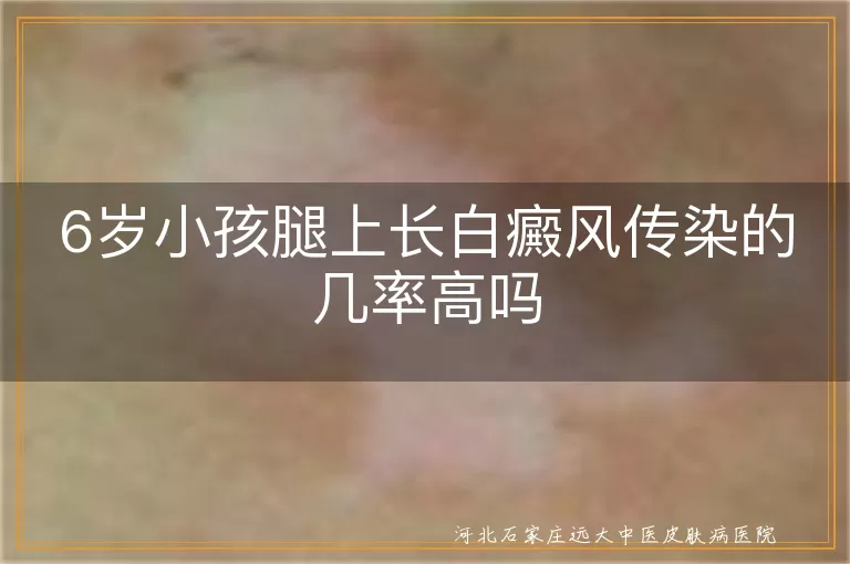 儿童腿部白癜风传染吗,小孩白斑会不会传染,6岁白癜风传染概率
