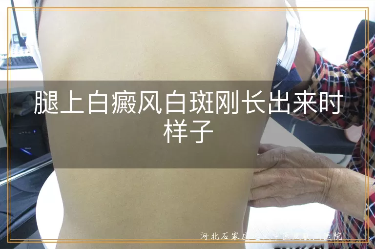 腿部白癜风早期表现,白斑初期症状特征,下肢皮肤色素脱失