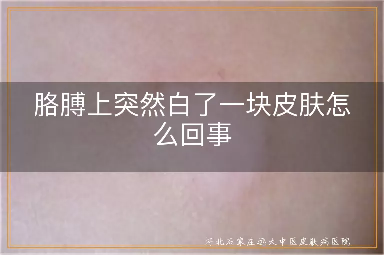 `胳膊上突然出现白癜风怎么回事,手臂皮肤突然变白是白癜风吗,胳膊白斑突然形成的原因`