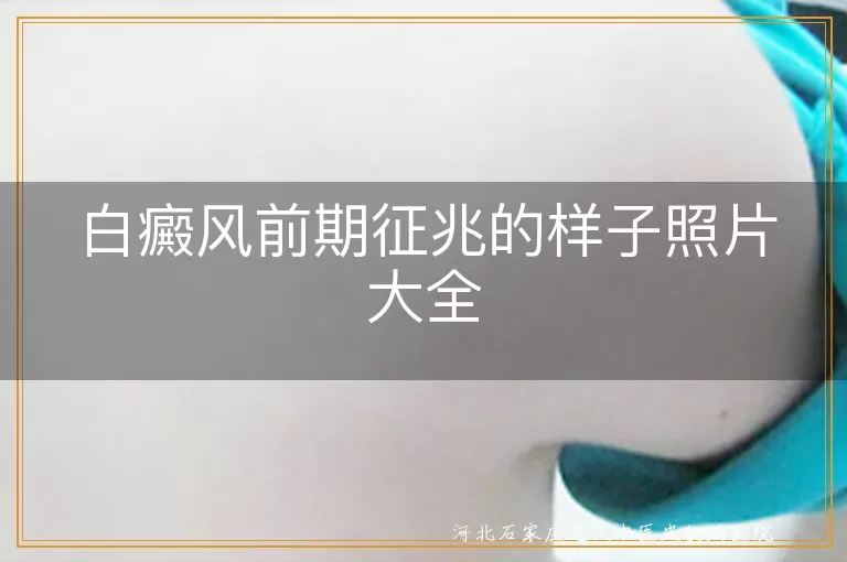 白癜风早期症状图片,白斑初期形态特征,白癜风皮损照片参考