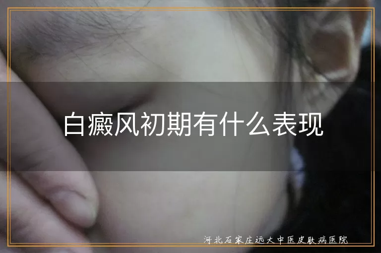 `白癜风初期症状有哪些,白斑早期识别方法,白癜风发病初期特征`