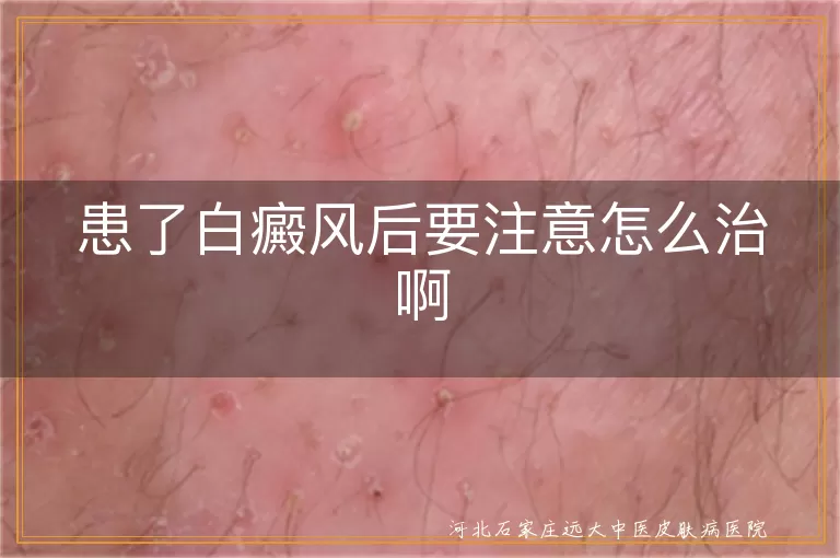 患了白癜风后要注意怎么治啊