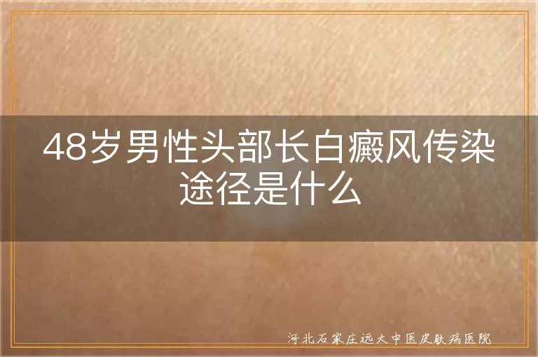 `头部白癜风疾病会不会传染他人,男性头皮白斑症状的传染途径,四十八岁白癜风患者传染风险`