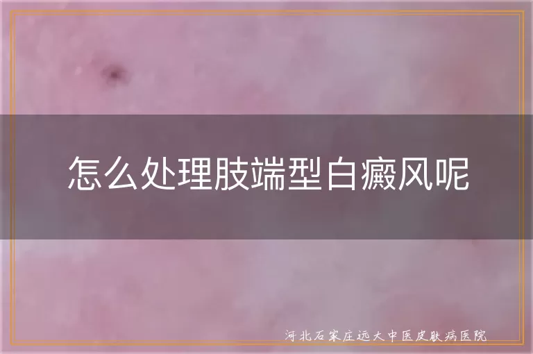 怎么处理肢端型白癜风呢