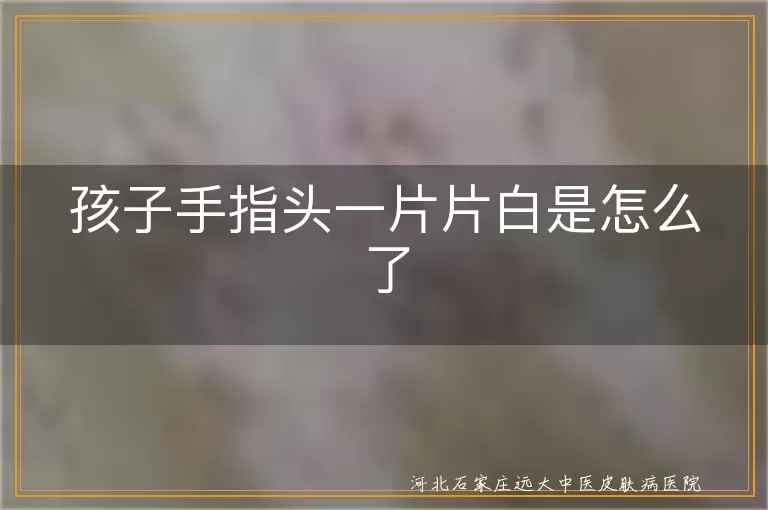 `儿童手指白斑是白癜风吗怎么判断,孩子手部出现白癜风白斑怎么办,小孩手指头长白斑是什么原因导致`
