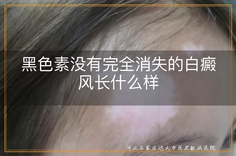 黑色素没有完全消失的白癜风长什么样