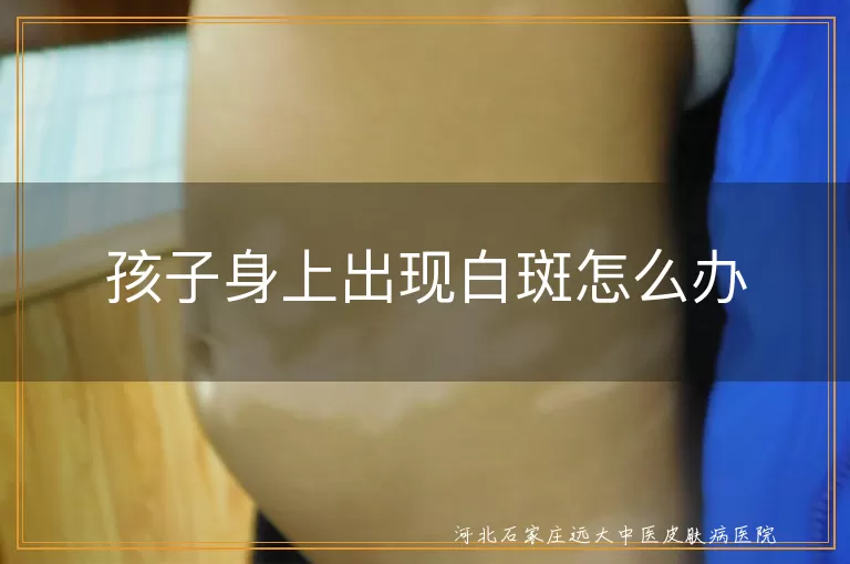 `孩子皮肤出现白斑是不是白癜风,儿童身上发现白斑应该如何处理,孩子身上长了白癜风怎么办才好`