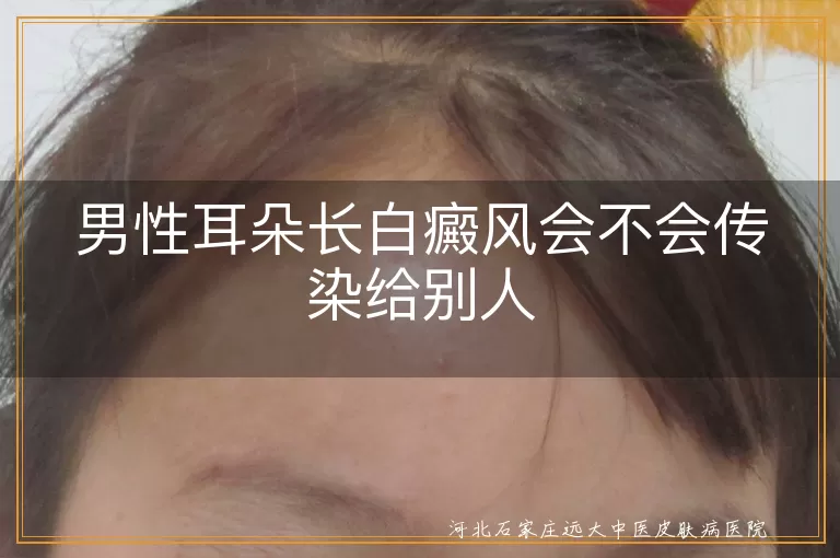 `耳部白癜风是否具有传染性风险,男性白斑皮损接触传播可能性分析,白癜风通过日常接触传染给家人吗`