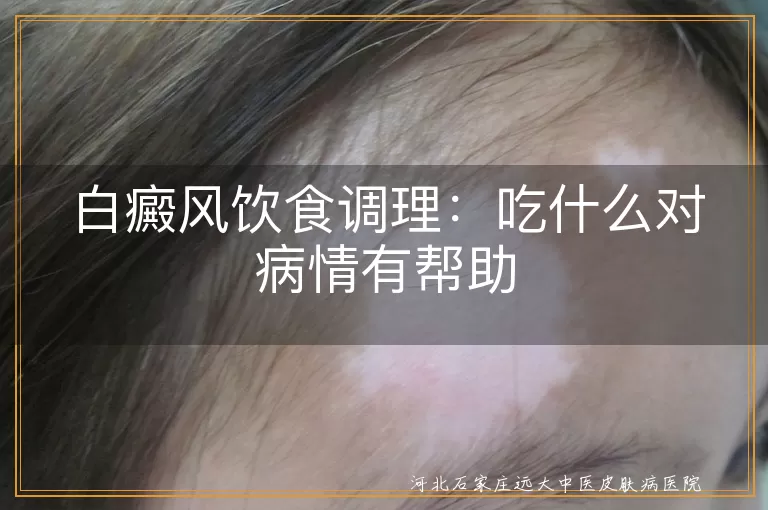 白癜风患者饮食注意事项有哪些,白斑患者日常饮食调理方法,白癜风饮食禁忌与营养搭配