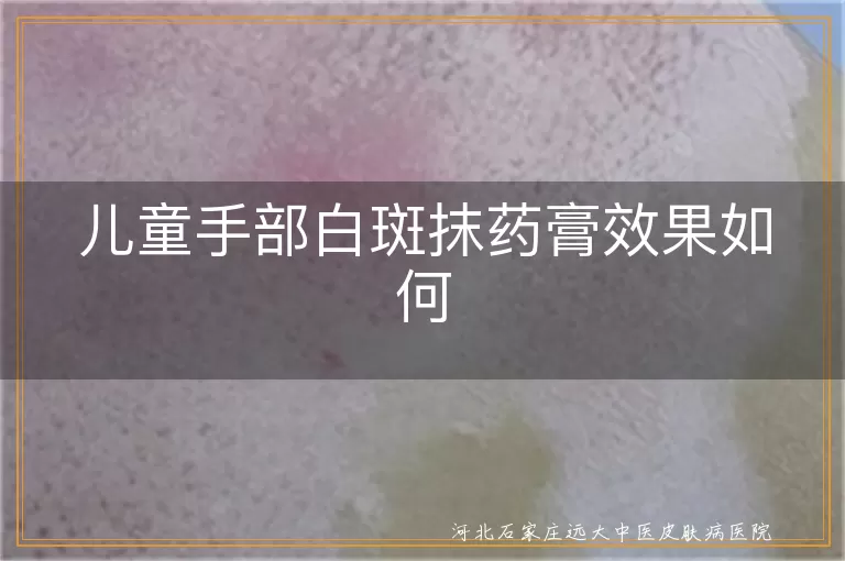 儿童手部白癜风抹药效果怎样,小孩手上有白斑涂药膏管用吗,孩子手部白斑用药治疗见效吗