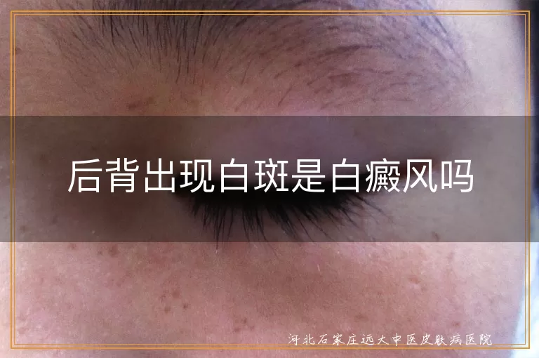 后背长白斑是不是白癜风,背部白斑是不是得了白癜风,后背出现白斑是白癜风吗
