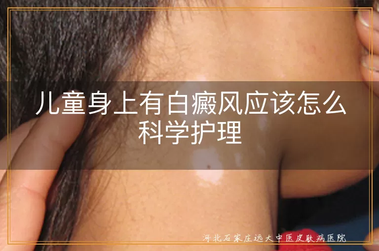 儿童身上有白癜风怎么护理,孩子得了白癜风如何护理,儿童白癜风日常护理方法