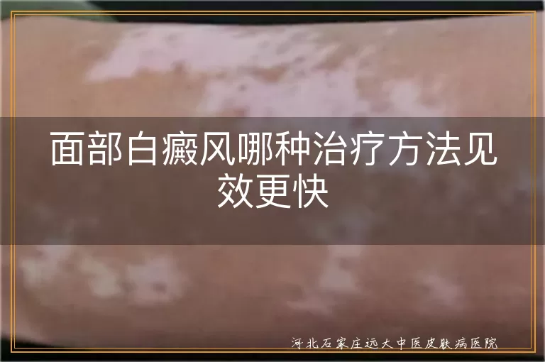 面部白癜风哪种治疗方法见效更快