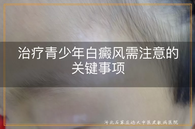 治疗青少年白癜风需注意的关键事项
