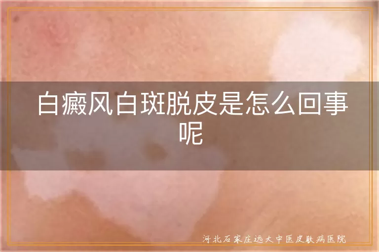 白癜风白斑脱皮是怎么回事呢
